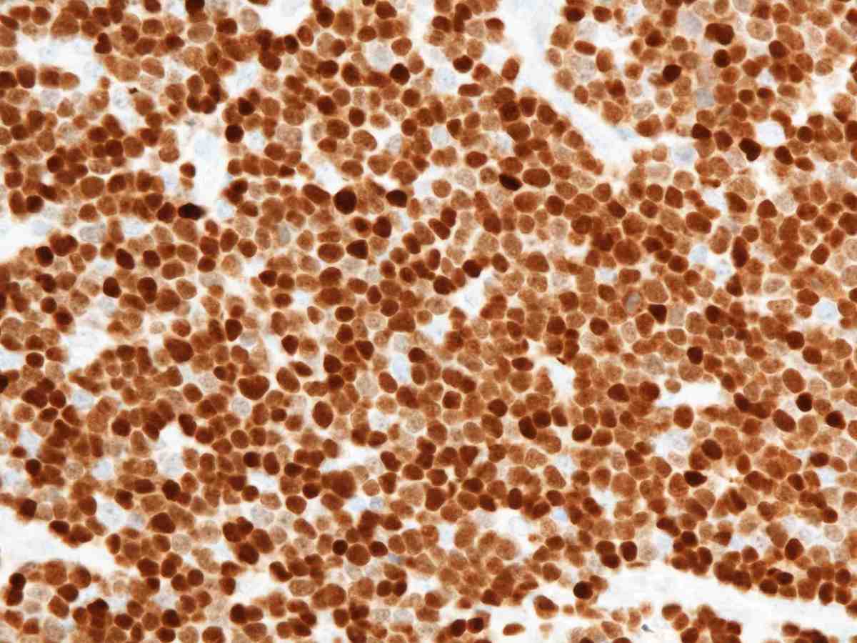 Lymph node 2012 TDT 40X